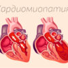 кардиомиопатии сердца